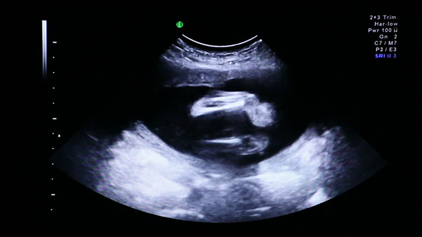 Ultrasound ecography. Gynecological medical examination. 22 weeks old pregnancy. 