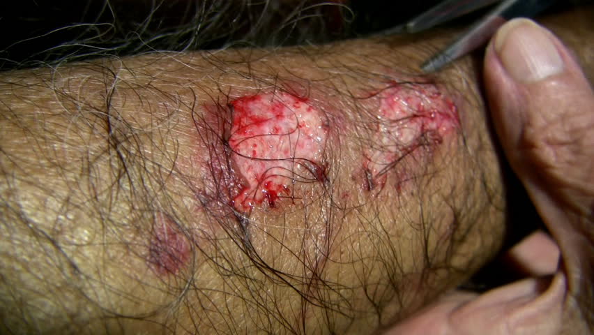 Injury