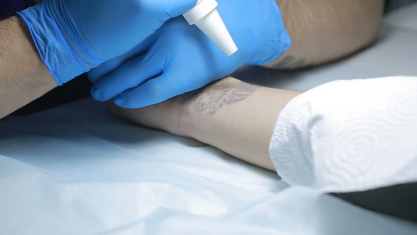 laser tattoo removal with hand stock footage video 22185067 laser tattoo removal with hand stock footage video 22185067