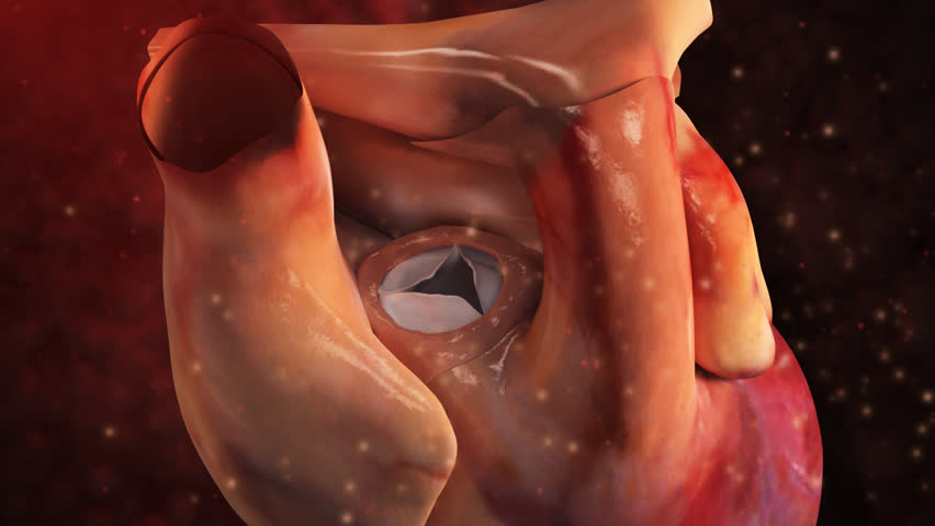 Zoom in to view human  aortic valve of heart and removal of  three-leafed incompetent leaky endocarditis aortic valve in 3D CG animal animated model 