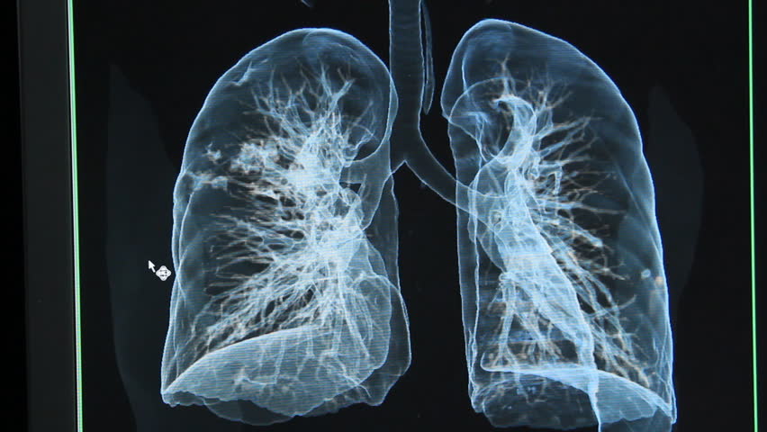 chest X-rays under 3d image ,lungs 3d image  