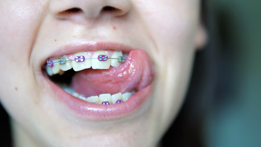 Beautiful Girl With Braces On His Teeth White Posing For The Camera ...
