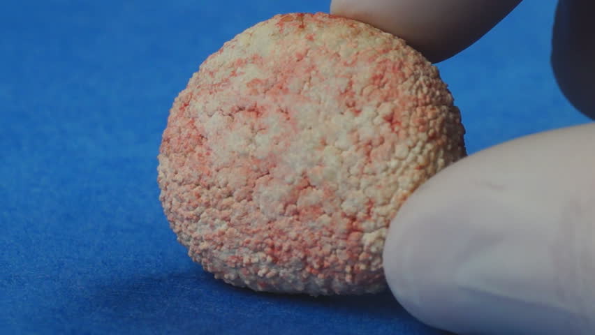 Veterinarian showing extremely large Bladder stone removed from a dog, calcium oxalate stone due to excessive calcium in diet