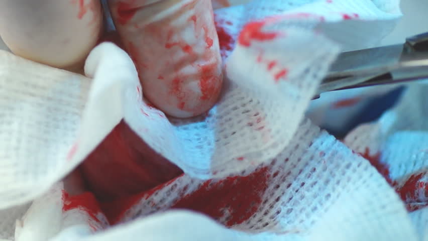 Veterinarian surgically removing large kidney stone in dog, calcium oxalate calculi due to excessive calcium in diet from feeding human food (cheese).