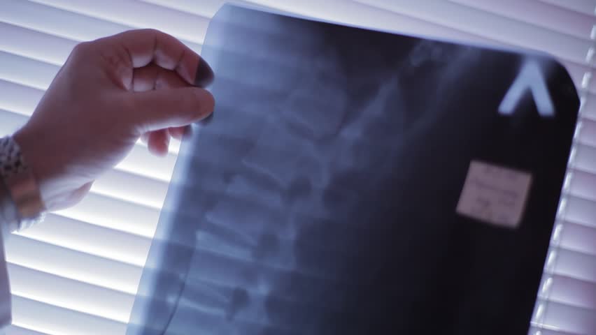 A doctor looked at the X-ray snapshot against the window. In the picture - vertebrate skeleton section his patient.