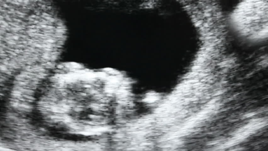 Medical ultrasound scan of human embryo		 