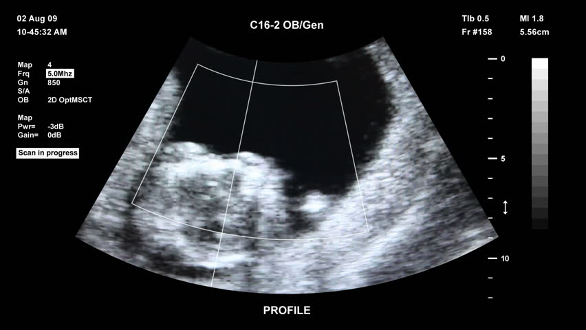 Medical ultrasound scan of human embryo		 