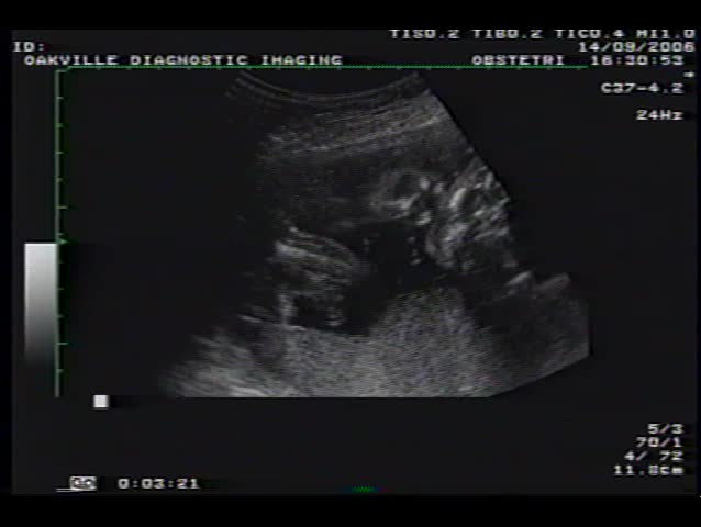 Ultrasound of 20 week old unboard baby boy