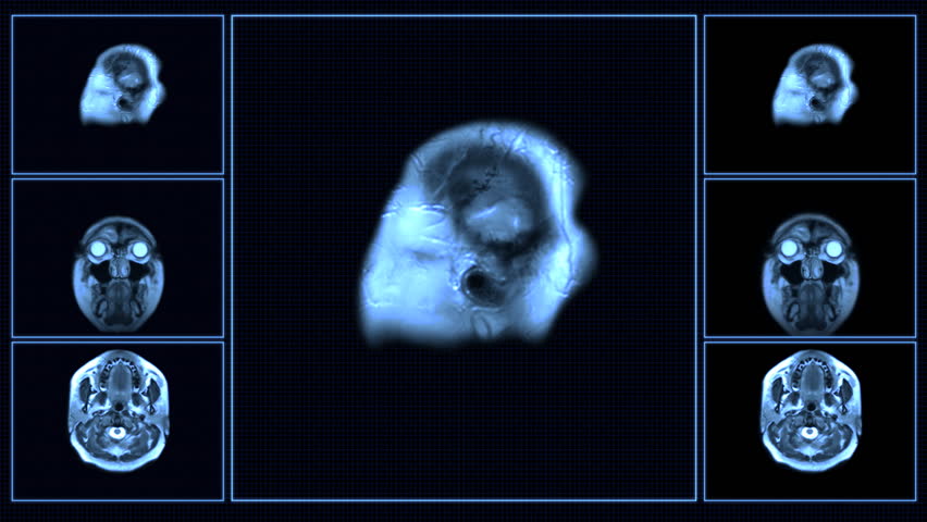 MRI brain scan