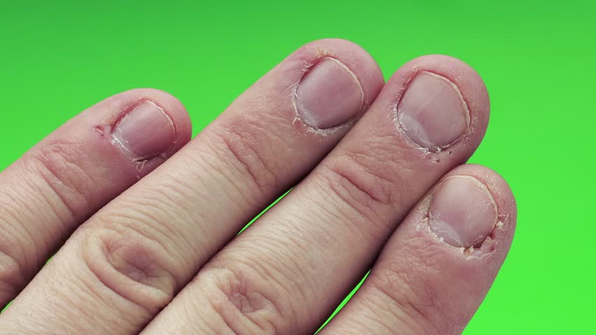 Nail Biting Cuticle Damage - Bios Pics