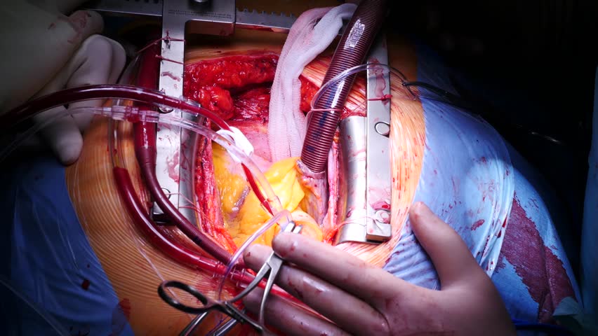 View of Coronary Artery Bypass Stock Footage Video (100% Royalty-free