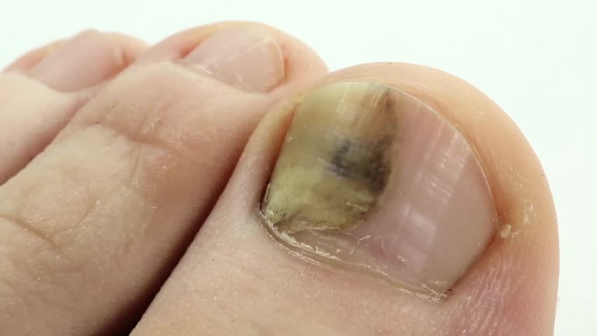 Image result for fungal nail infection