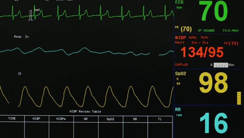 Looping Animation Of A Medical Hospital Monitor Of Normal Vital Signs