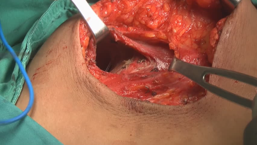 breast augmentation surgery video Ebony porn girls