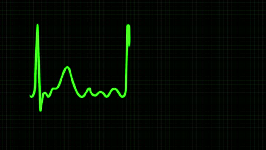 cardiograph bpm normal